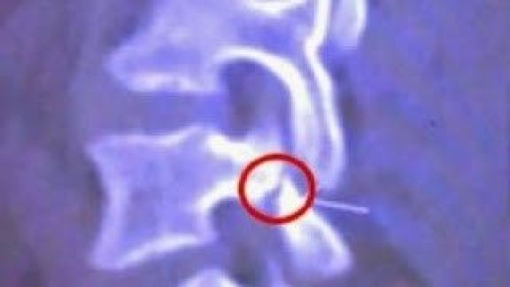 Mirá la radiografía de Neymar